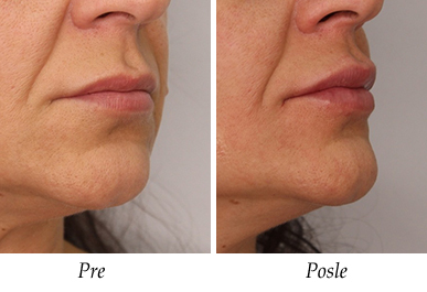 Korekcija usiju pre i posle pacijent 2