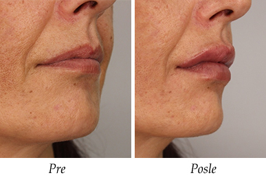 Korekcija usiju pre i posle pacijent 2