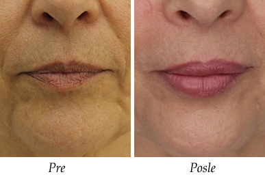 Korekcija usiju pre i posle pacijent 2