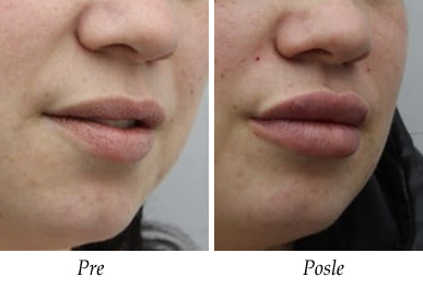 Galerija Pre i Posle - Korekcija ušiju pacijent 1