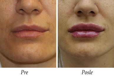 Korekcija usiju pre i posle pacijent 2