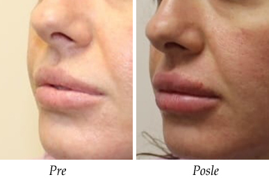 Galerija Pre i Posle - Korekcija ušiju pacijent 1