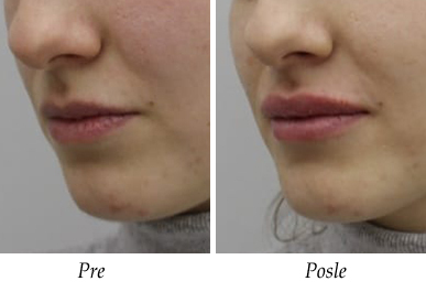 Korekcija usiju pre i posle pacijent 2