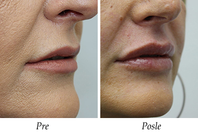 Korekcija usiju pre i posle pacijent 2