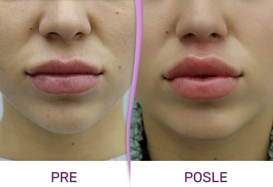 bullhorn lift isecanje kože ispod nosa