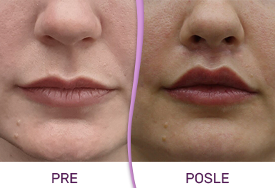 Operacija bullhorn lip lift