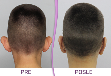 Galerija Pre i Posle - Korekcija ušiju